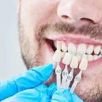 Установка зубных виниров и брекетов: основные моменты и особенности